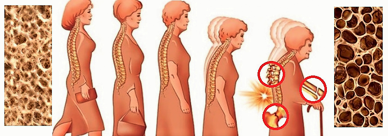 Старческий остеопороз. Сенильный остеопороз. Возрастной остеопороз. Менопаузальный остеопороз.